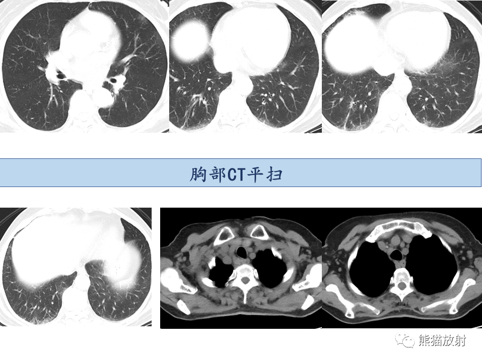 影像PPT - 【病例】IgG4相关硬化性胆管炎及肾炎2例-24