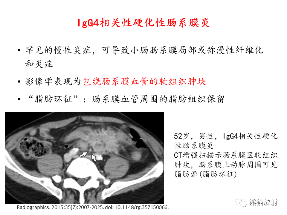 影像PPT - 【病例】IgG4相关硬化性胆管炎及肾炎2例-56