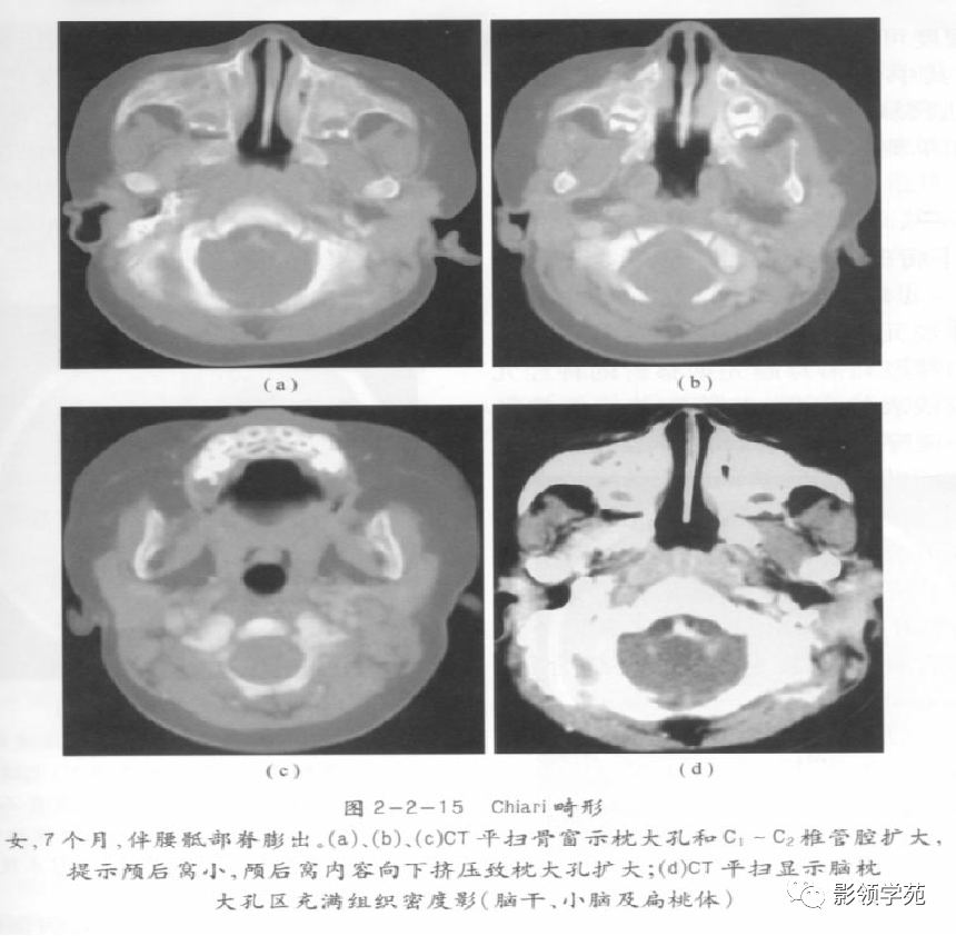 影像PPT - 脊髓空洞症影像学表现-8 影像PPT - 脊髓空洞症影像学表现-8