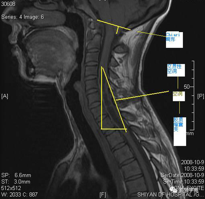 影像PPT - 脊髓空洞症影像学表现-19 影像PPT - 脊髓空洞症影像学表现-19