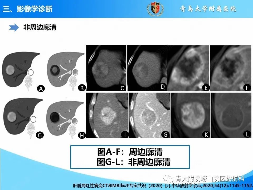 影像PPT - 【PPT】肝细胞癌的影像学诊断与鉴别诊断-10