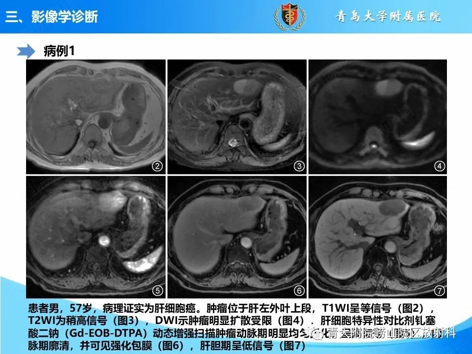 影像PPT - 【PPT】肝细胞癌的影像学诊断与鉴别诊断-15