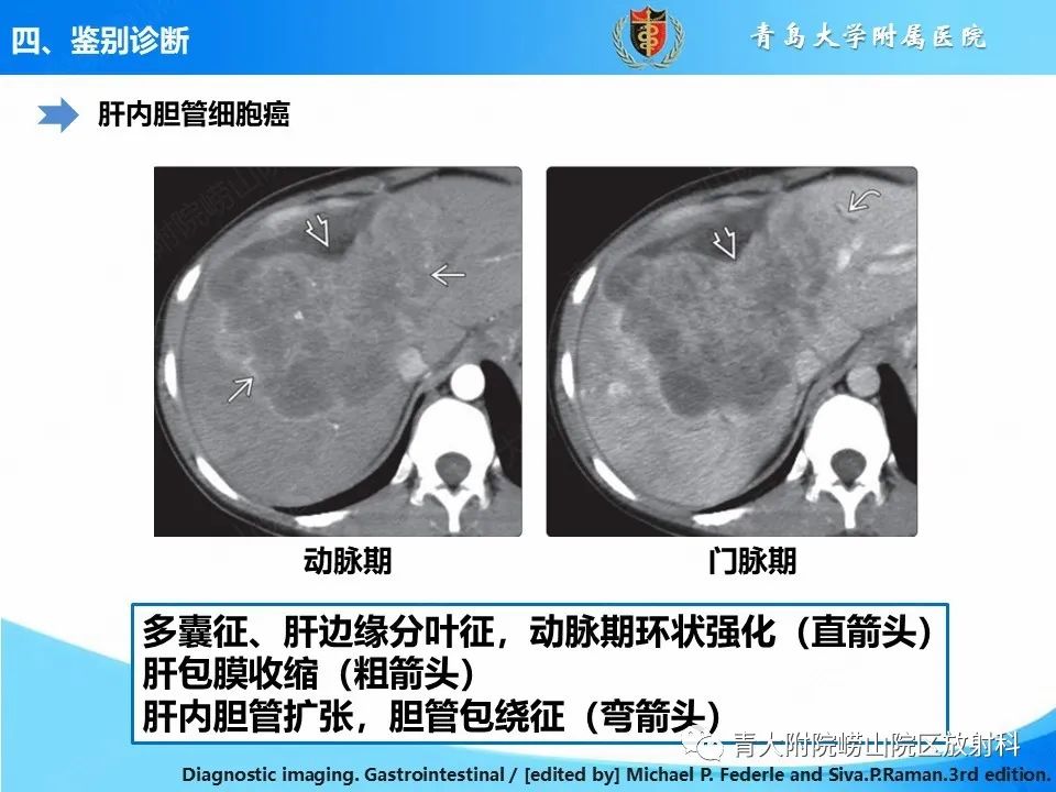 影像PPT - 【PPT】肝细胞癌的影像学诊断与鉴别诊断-20