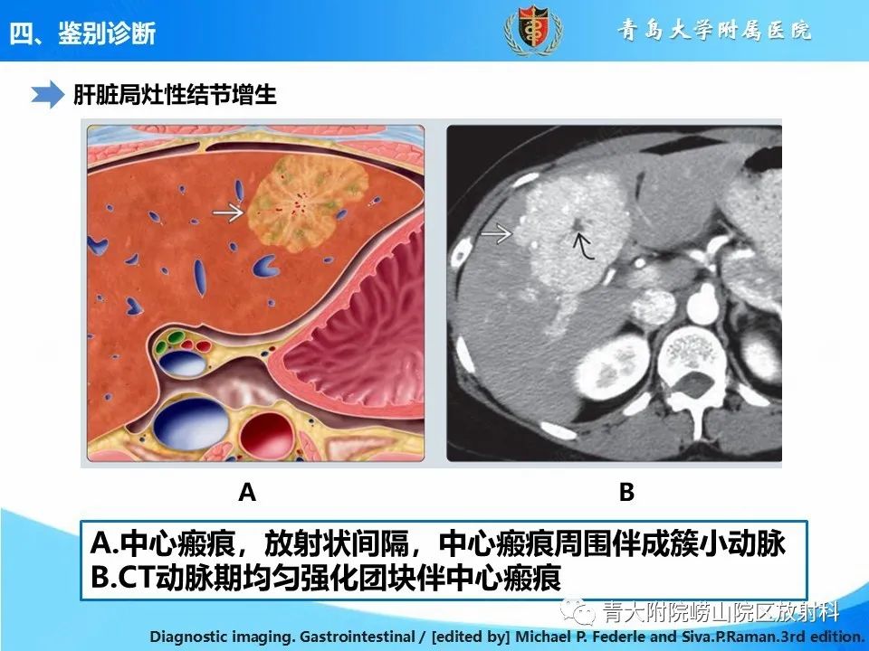 影像PPT - 【PPT】肝细胞癌的影像学诊断与鉴别诊断-29