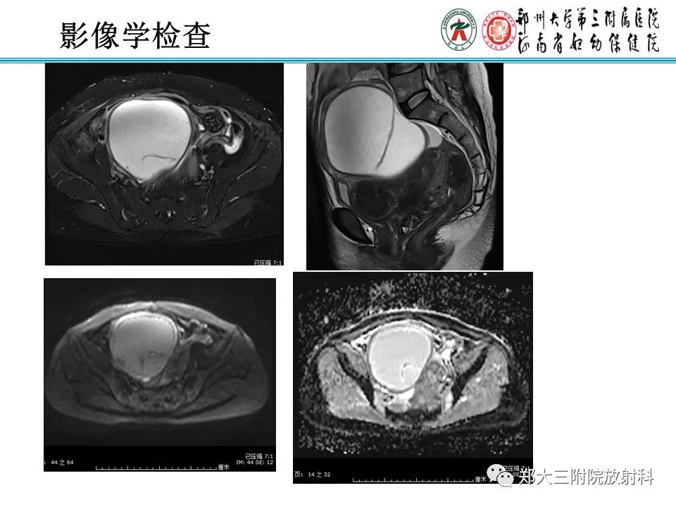 影像PPT - 【PPT】输卵管积液的诊断-3