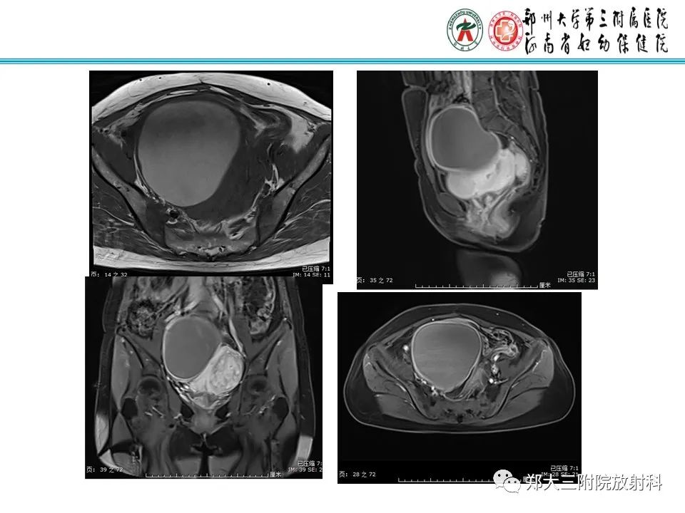 影像PPT - 【PPT】输卵管积液的诊断-4