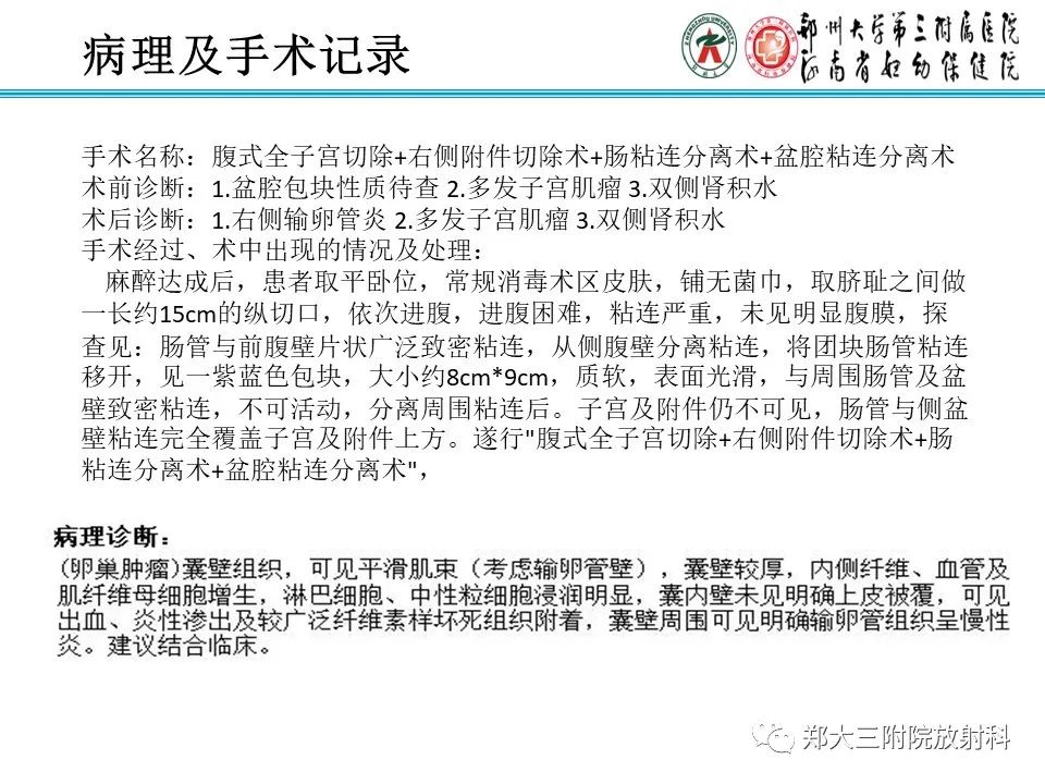 影像PPT - 【PPT】输卵管积液的诊断-6