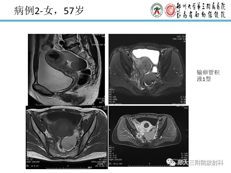 影像PPT - 【PPT】输卵管积液的诊断-9