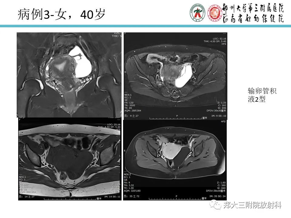 影像PPT - 【PPT】输卵管积液的诊断-10