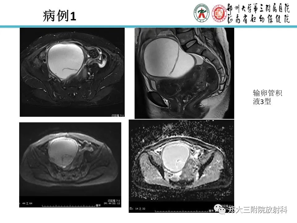 影像PPT - 【PPT】输卵管积液的诊断-11