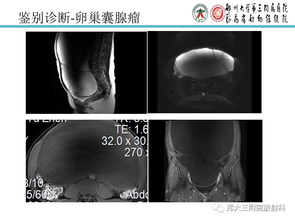影像PPT - 【PPT】输卵管积液的诊断-13