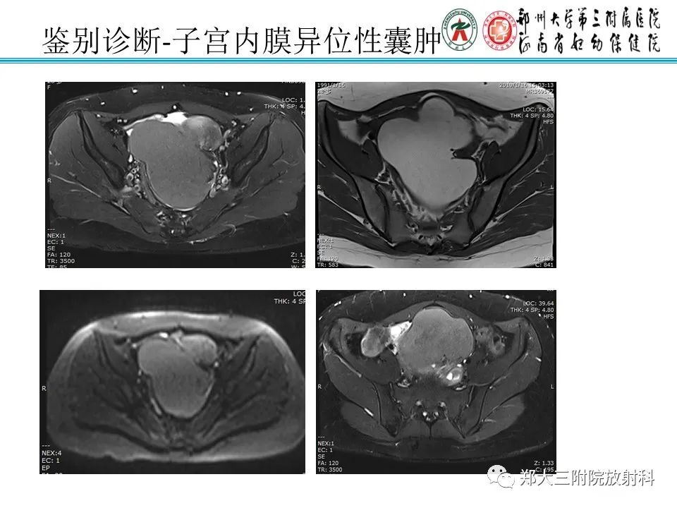 影像PPT - 【PPT】输卵管积液的诊断-15