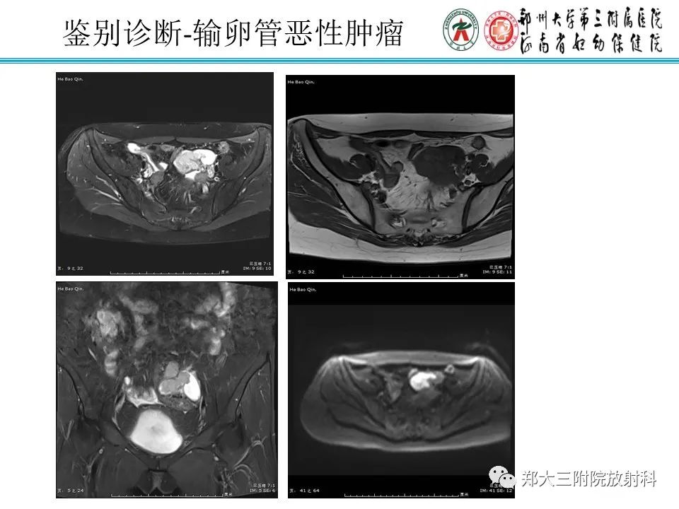 影像PPT - 【PPT】输卵管积液的诊断-17