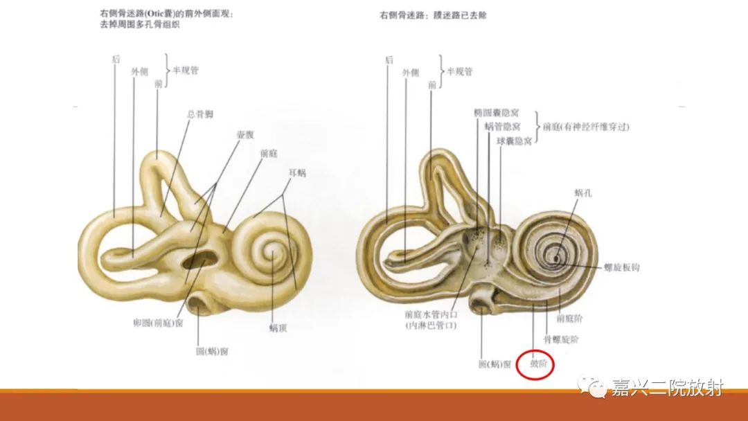 影像PPT - 【PPT】迷路炎的影像学诊断-3