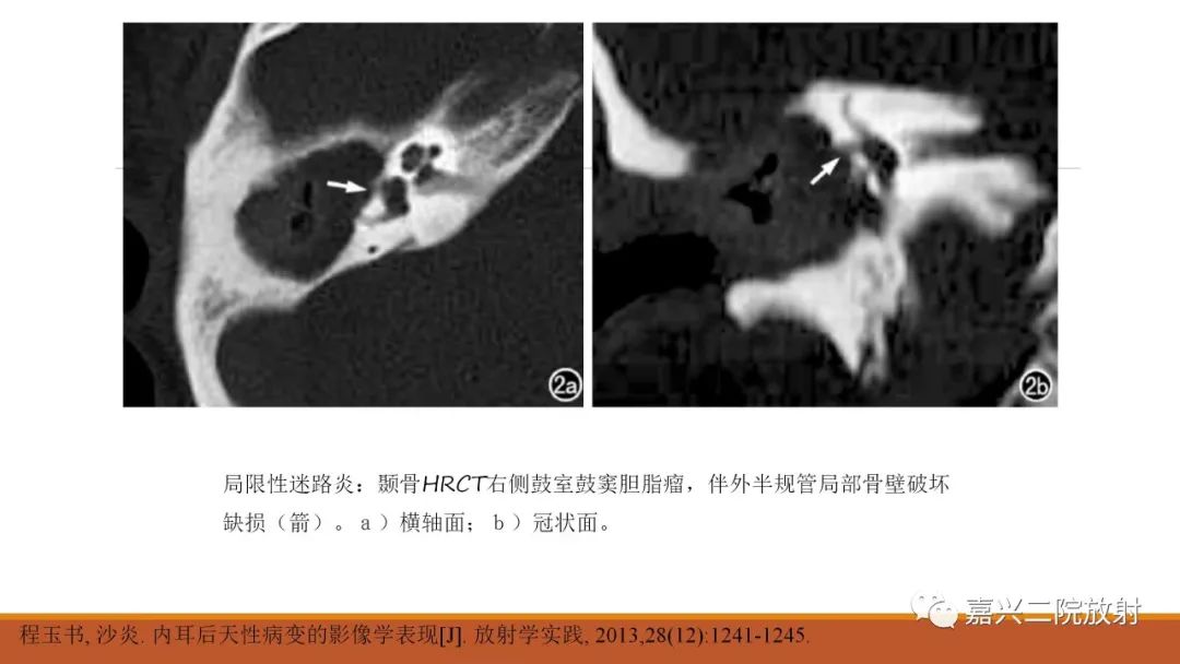 影像PPT - 【PPT】迷路炎的影像学诊断-12