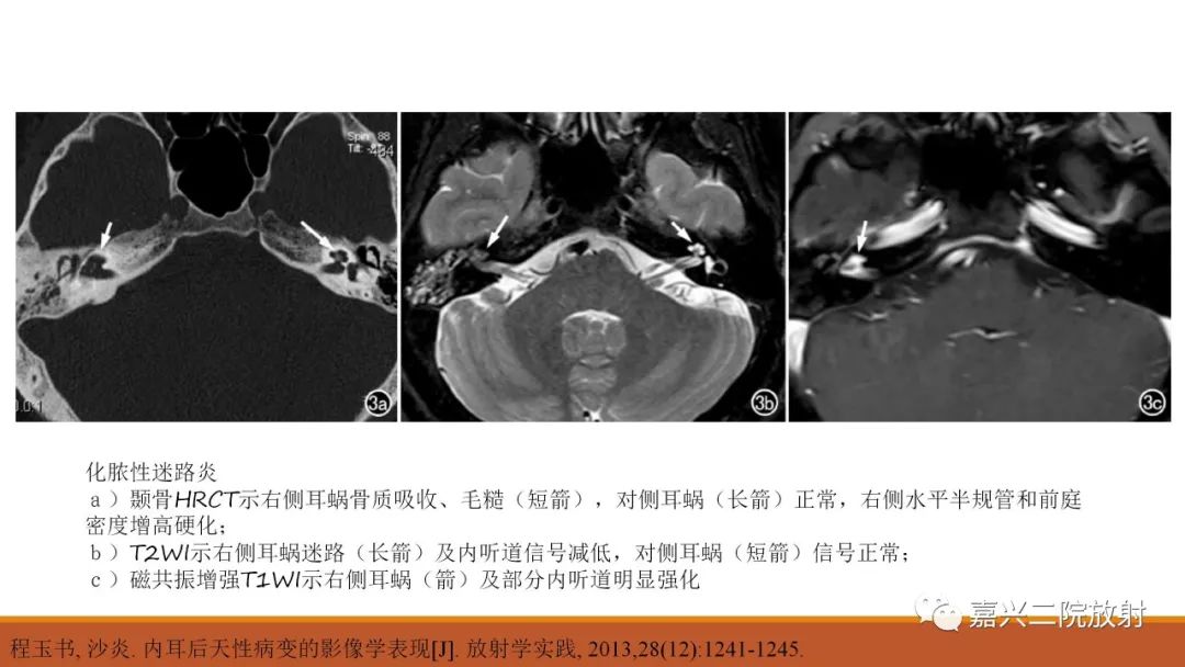 影像PPT - 【PPT】迷路炎的影像学诊断-14