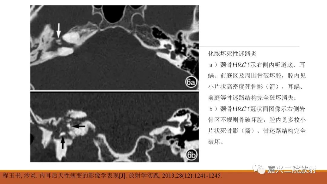 影像PPT - 【PPT】迷路炎的影像学诊断-16
