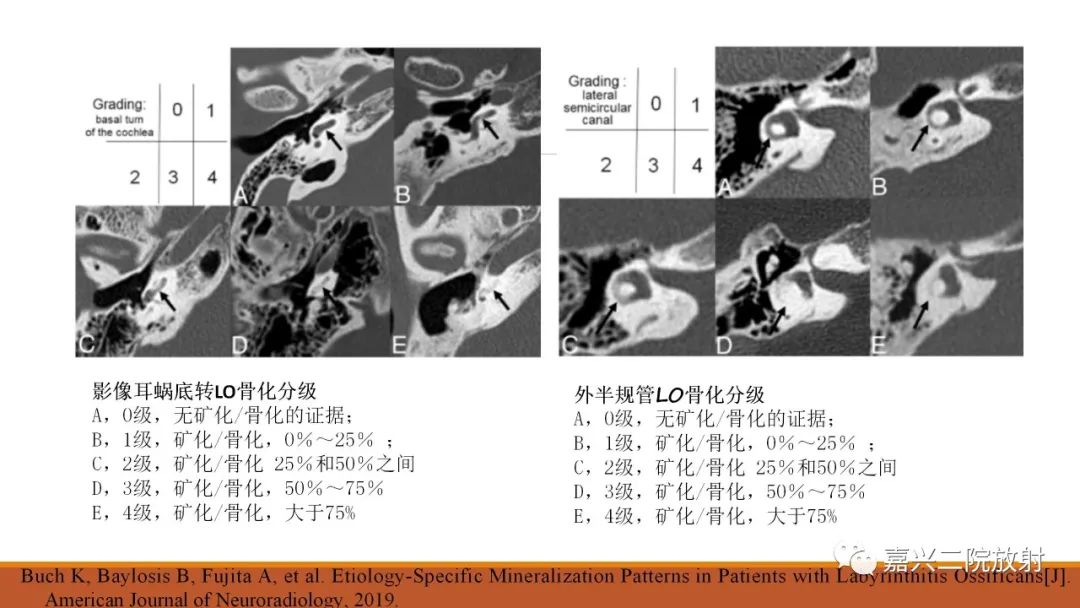 影像PPT - 【PPT】迷路炎的影像学诊断-20