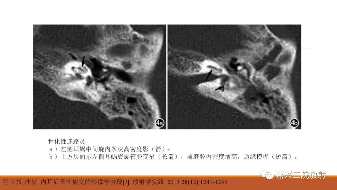 影像PPT - 【PPT】迷路炎的影像学诊断-21