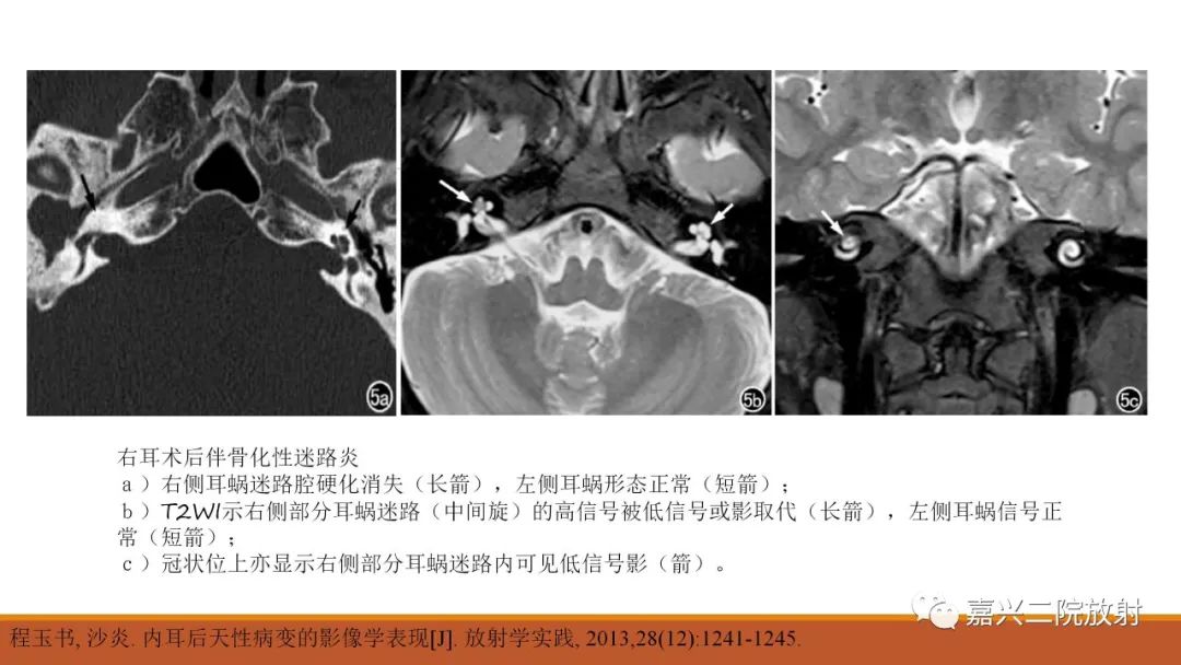 影像PPT - 【PPT】迷路炎的影像学诊断-22