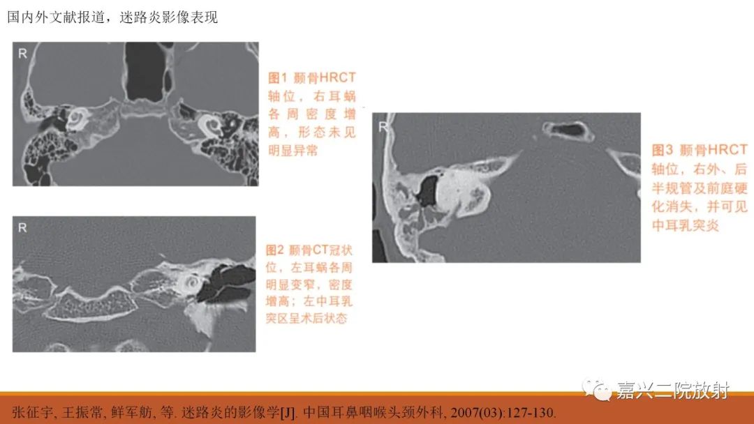 影像PPT - 【PPT】迷路炎的影像学诊断-25