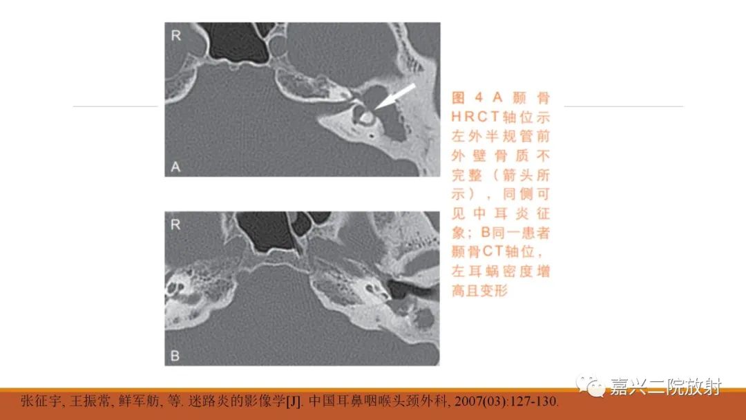 影像PPT - 【PPT】迷路炎的影像学诊断-26