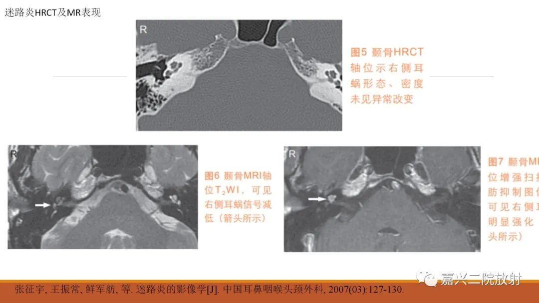 影像PPT - 【PPT】迷路炎的影像学诊断-27