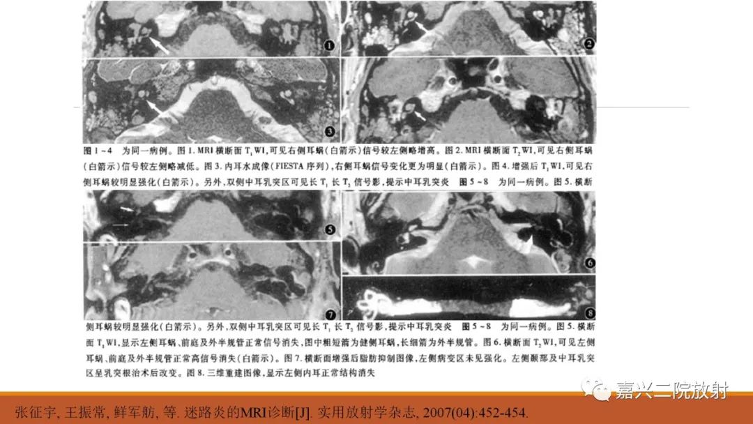 影像PPT - 【PPT】迷路炎的影像学诊断-28