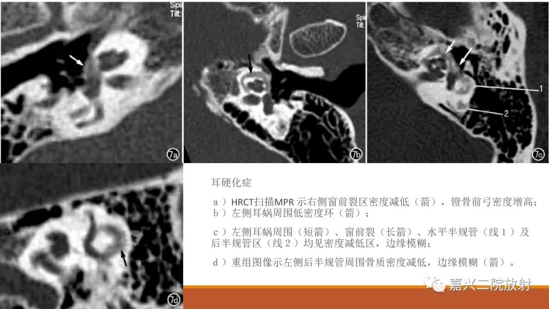 影像PPT - 【PPT】迷路炎的影像学诊断-41