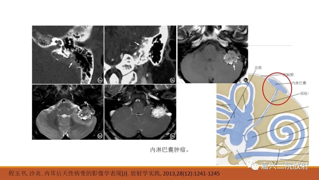 影像PPT - 【PPT】迷路炎的影像学诊断-43