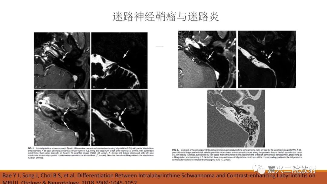 影像PPT - 【PPT】迷路炎的影像学诊断-48