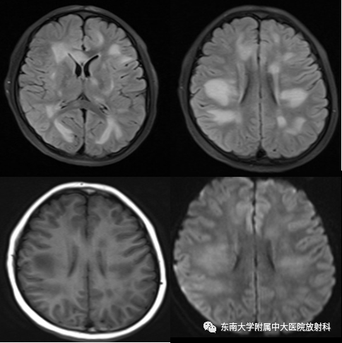影像PPT - 【病例】急性播散性脑脊髓炎1例MR影像-2 影像PPT - 【病例】急性播散性脑脊髓炎1例MR影像-2