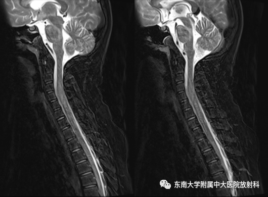 影像PPT - 【病例】急性播散性脑脊髓炎1例MR影像-3 影像PPT - 【病例】急性播散性脑脊髓炎1例MR影像-3