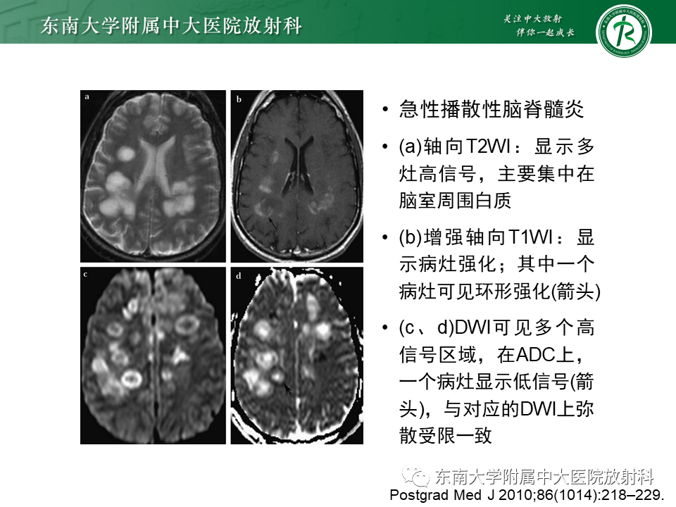 影像PPT - 【病例】急性播散性脑脊髓炎1例MR影像-13 影像PPT - 【病例】急性播散性脑脊髓炎1例MR影像-13