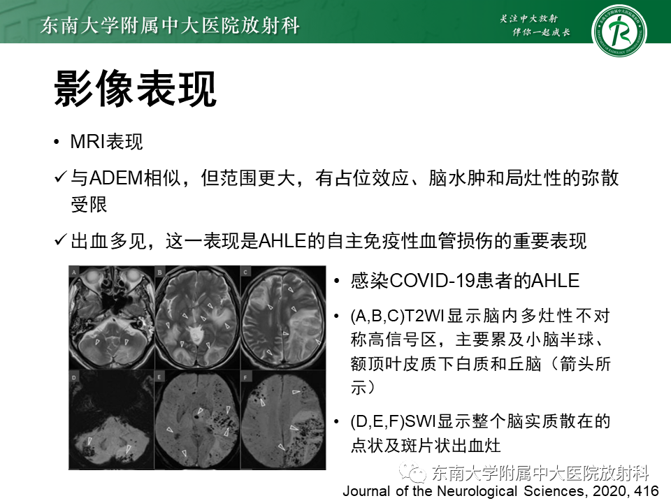 影像PPT - 【病例】急性播散性脑脊髓炎1例MR影像-15 影像PPT - 【病例】急性播散性脑脊髓炎1例MR影像-15