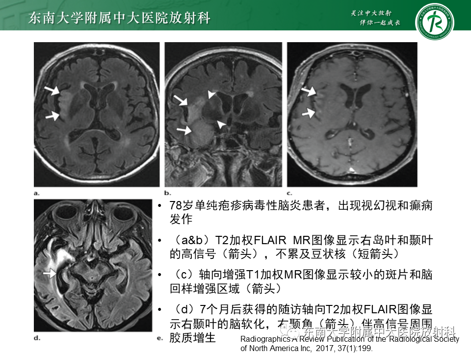影像PPT - 【病例】急性播散性脑脊髓炎1例MR影像-21 影像PPT - 【病例】急性播散性脑脊髓炎1例MR影像-21