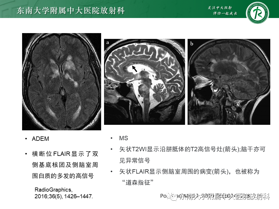 影像PPT - 【病例】急性播散性脑脊髓炎1例MR影像-24 影像PPT - 【病例】急性播散性脑脊髓炎1例MR影像-24