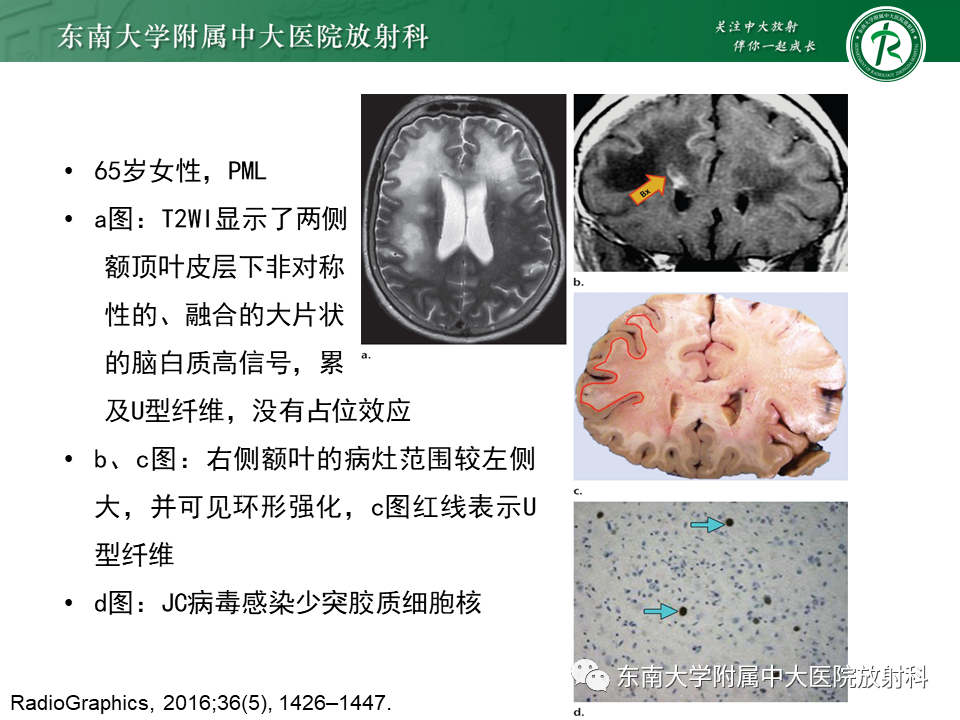 影像PPT - 【病例】急性播散性脑脊髓炎1例MR影像-26 影像PPT - 【病例】急性播散性脑脊髓炎1例MR影像-26