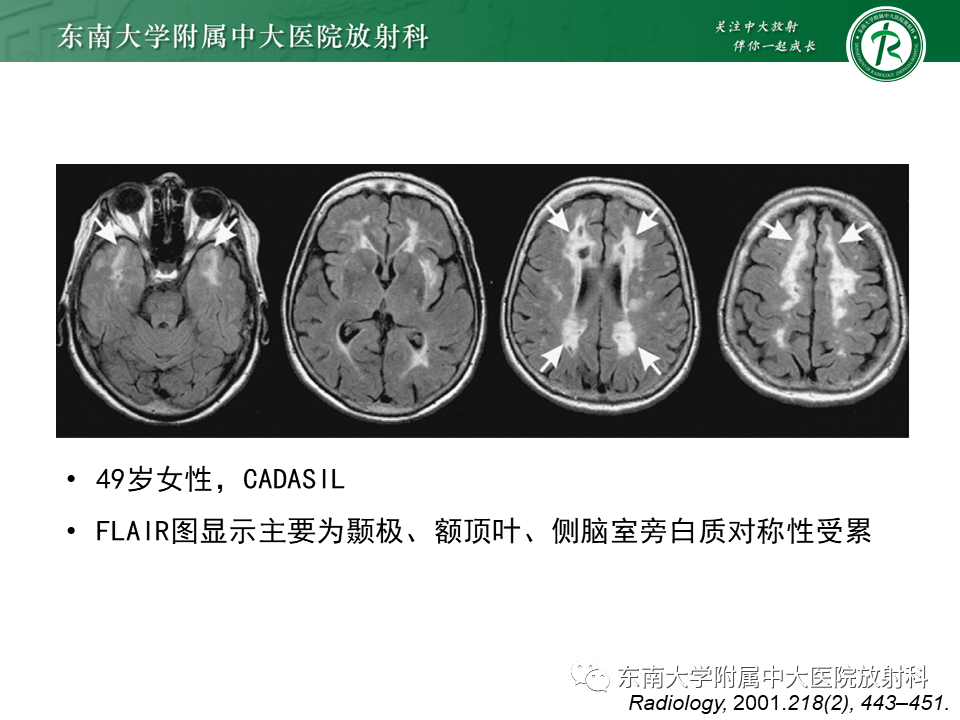 影像PPT - 【病例】急性播散性脑脊髓炎1例MR影像-29 影像PPT - 【病例】急性播散性脑脊髓炎1例MR影像-29