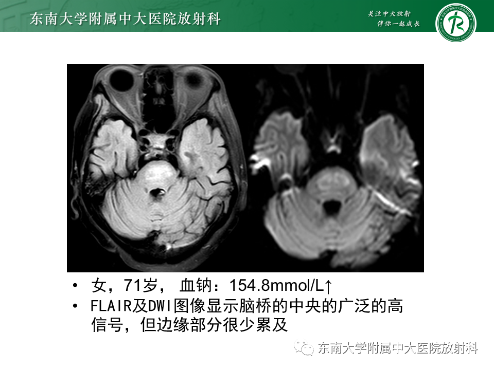 影像PPT - 【病例】急性播散性脑脊髓炎1例MR影像-32 影像PPT - 【病例】急性播散性脑脊髓炎1例MR影像-32