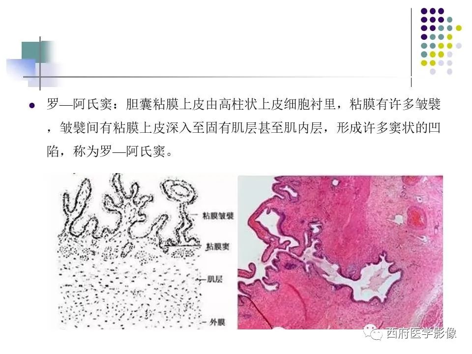 影像PPT - 【PPT】黄色肉芽肿性胆囊炎的影像诊断-4