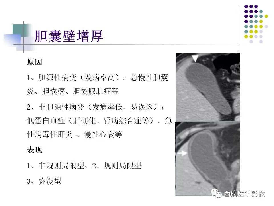 影像PPT - 【PPT】黄色肉芽肿性胆囊炎的影像诊断-6