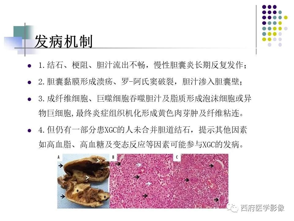 影像PPT - 【PPT】黄色肉芽肿性胆囊炎的影像诊断-8