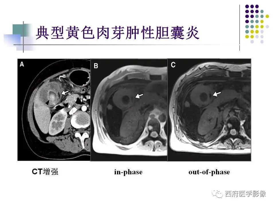 影像PPT - 【PPT】黄色肉芽肿性胆囊炎的影像诊断-18