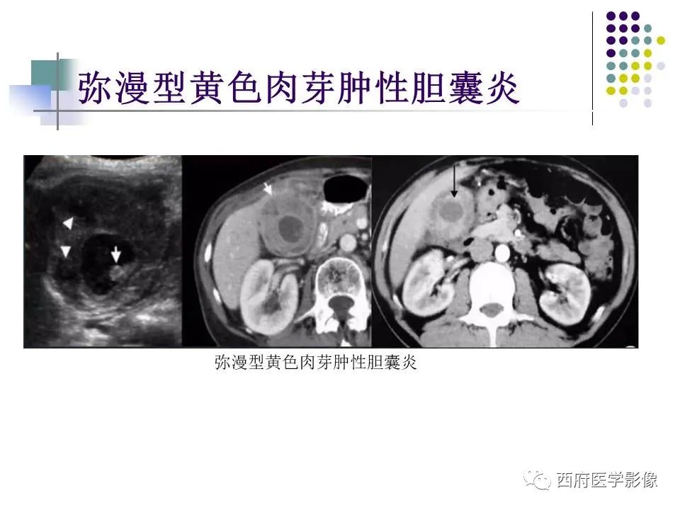 影像PPT - 【PPT】黄色肉芽肿性胆囊炎的影像诊断-19