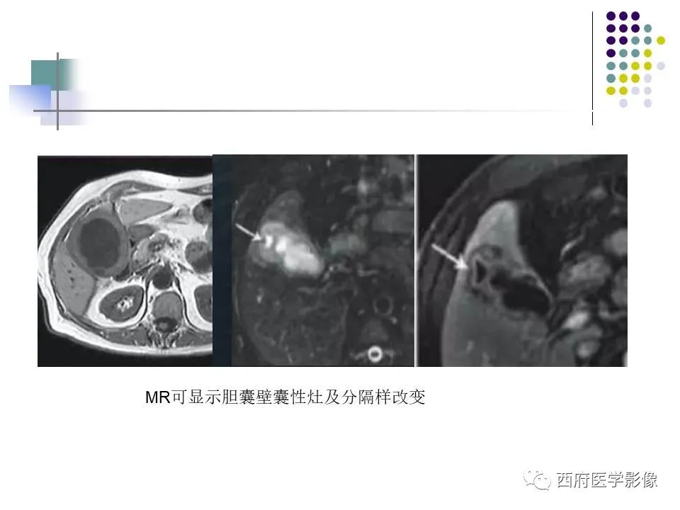 影像PPT - 【PPT】黄色肉芽肿性胆囊炎的影像诊断-20