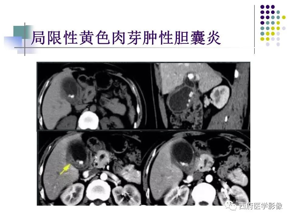 影像PPT - 【PPT】黄色肉芽肿性胆囊炎的影像诊断-21