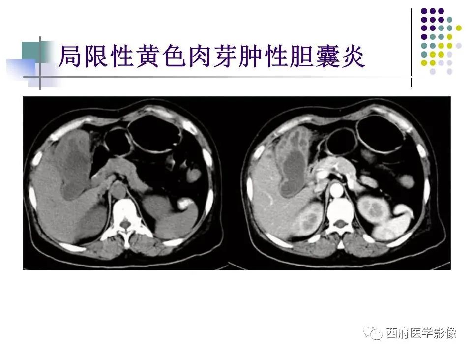 影像PPT - 【PPT】黄色肉芽肿性胆囊炎的影像诊断-22