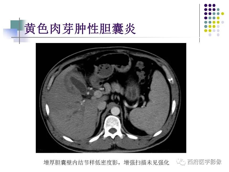 影像PPT - 【PPT】黄色肉芽肿性胆囊炎的影像诊断-23