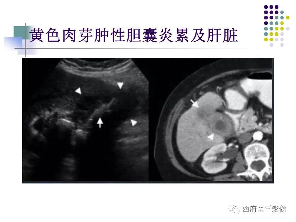 影像PPT - 【PPT】黄色肉芽肿性胆囊炎的影像诊断-24
